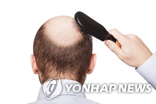 [특징주] 탈모 관련주, 건보 적용 추진 계획 소식에 급등(종합)